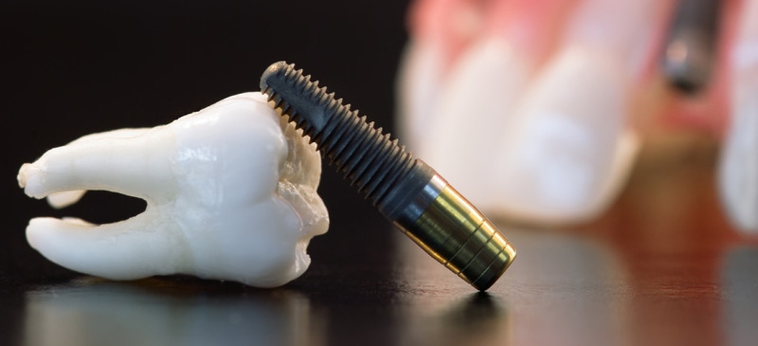 Oralna hirurgija - stomatolog Čačak